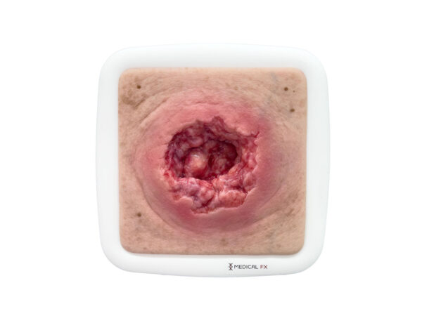 Rahmenmodell Dekubitus mit zerklüftetem Wundrand