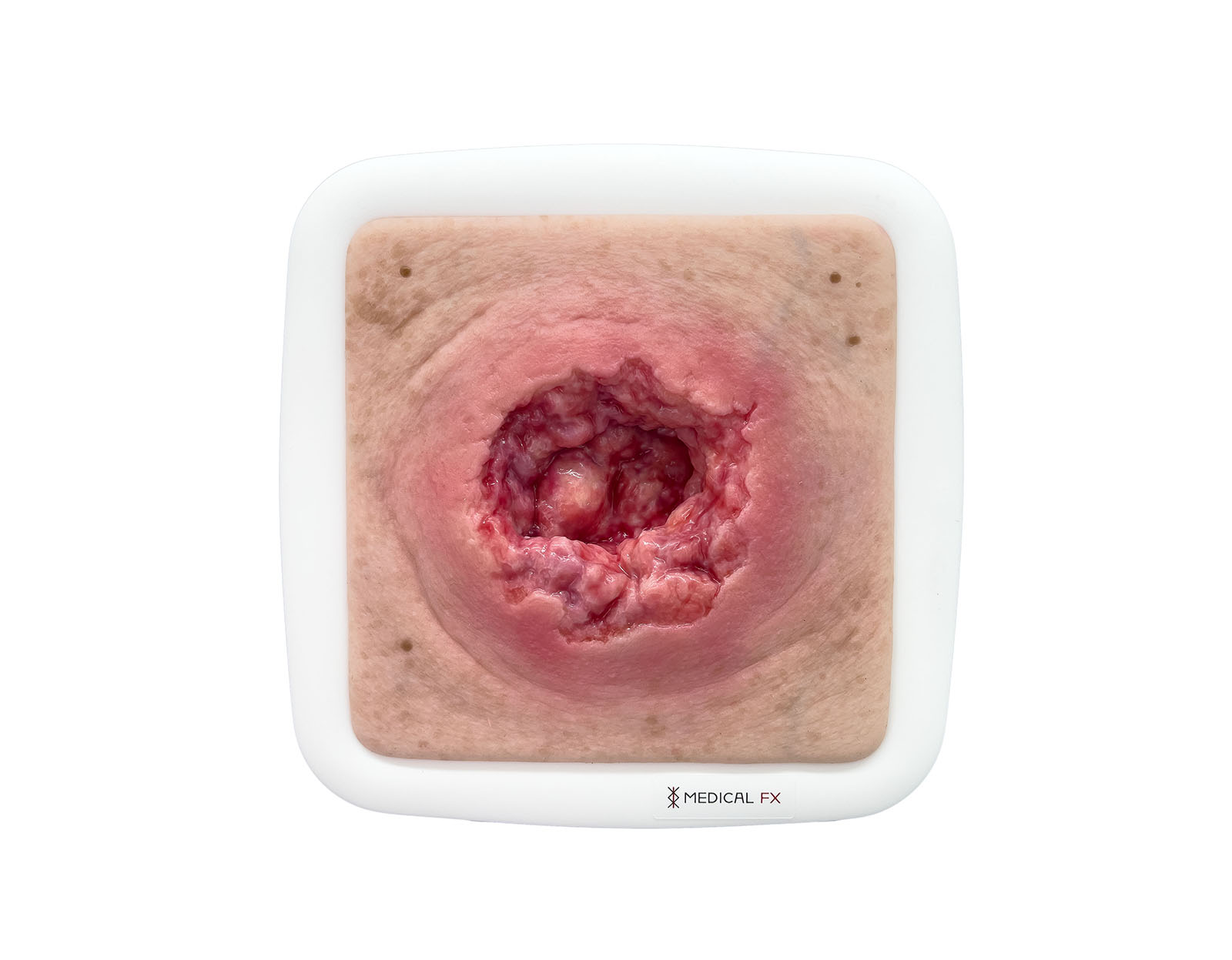 Rahmenmodell Dekubitus mit zerklüftetem Wundrand – Bild 1