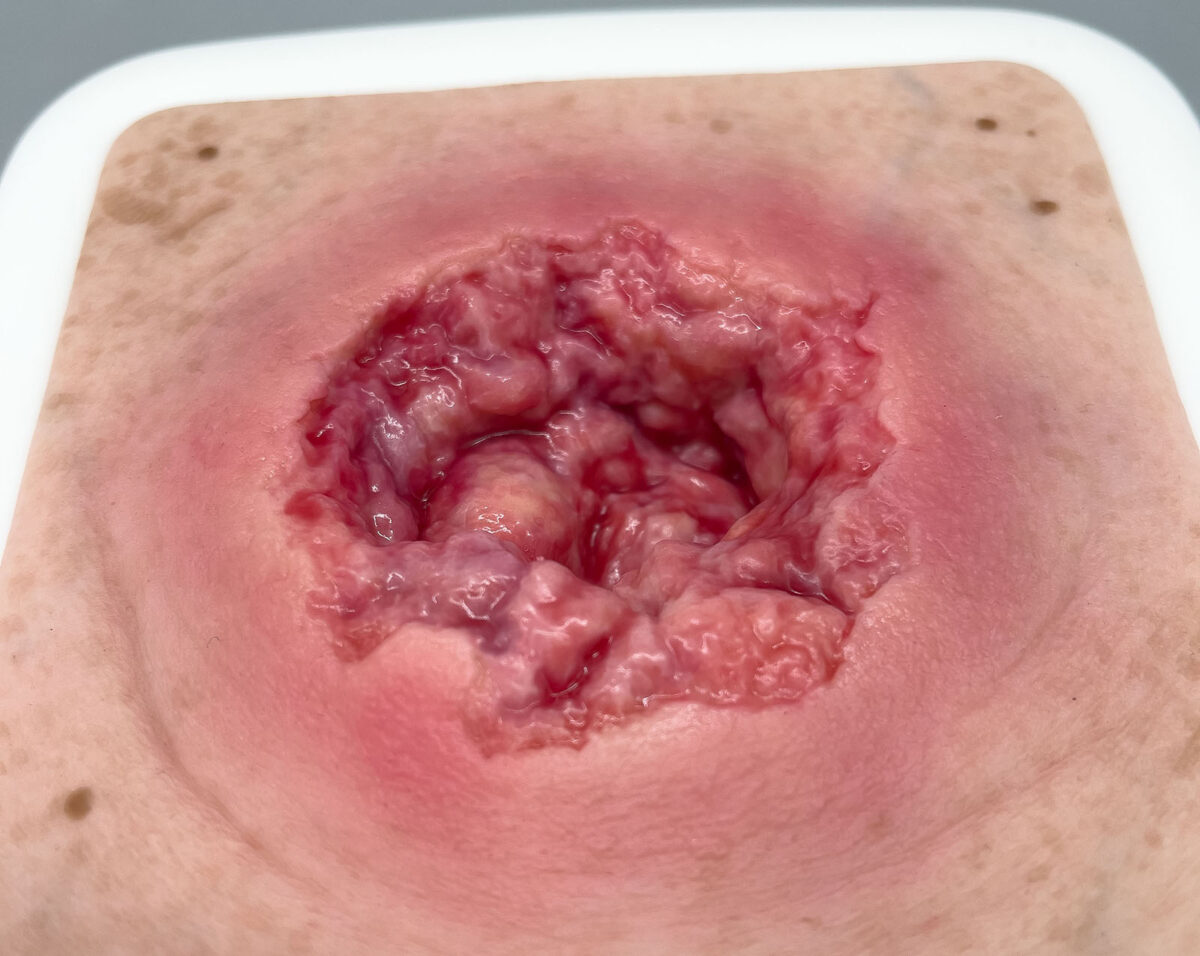 Rahmenmodell Dekubitus mit zerklüftetem Wundrand