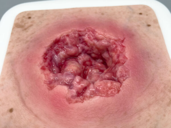 Rahmenmodell Dekubitus mit zerklüftetem Wundrand – Bild 2