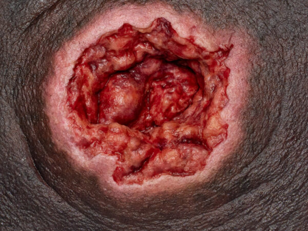 Rahmenmodell Dekubitus mit zerklüftetem Wundrand – Bild 6