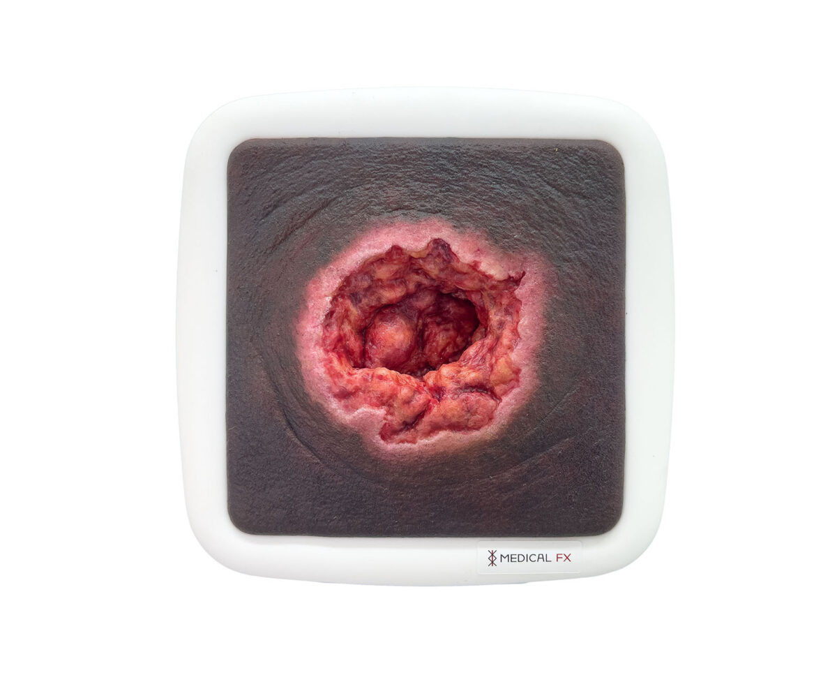 Rahmenmodell Dekubitus mit zerklüftetem Wundrand