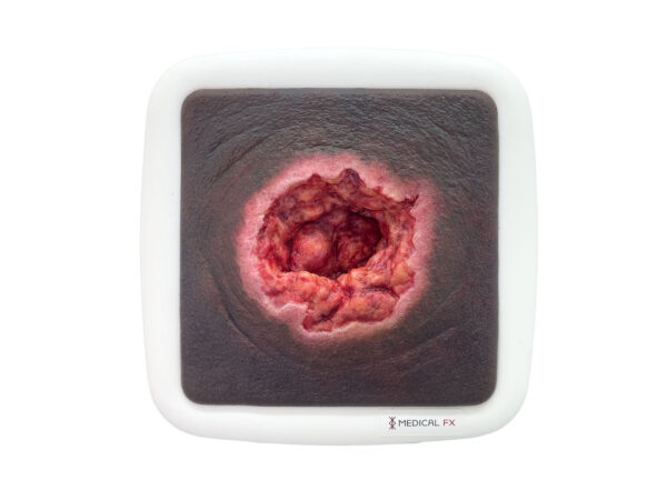 Rahmenmodell Dekubitus mit zerklüftetem Wundrand – Bild 7