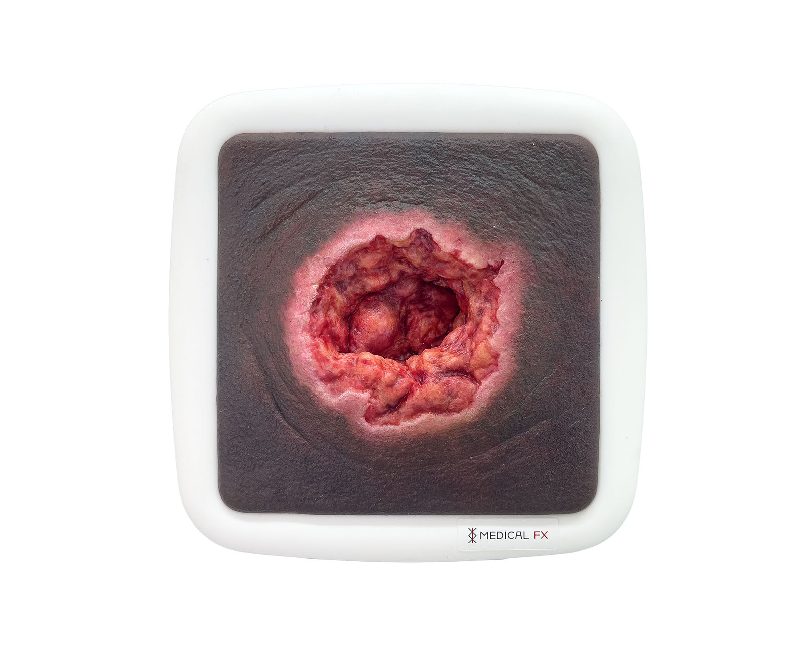 Rahmenmodell Dekubitus mit zerklüftetem Wundrand – Bild 7