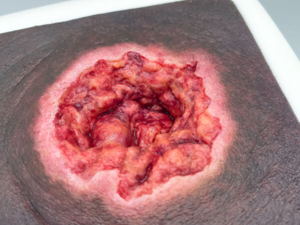 Rahmenmodell Dekubitus mit zerklüftetem Wundrand – Bild 4