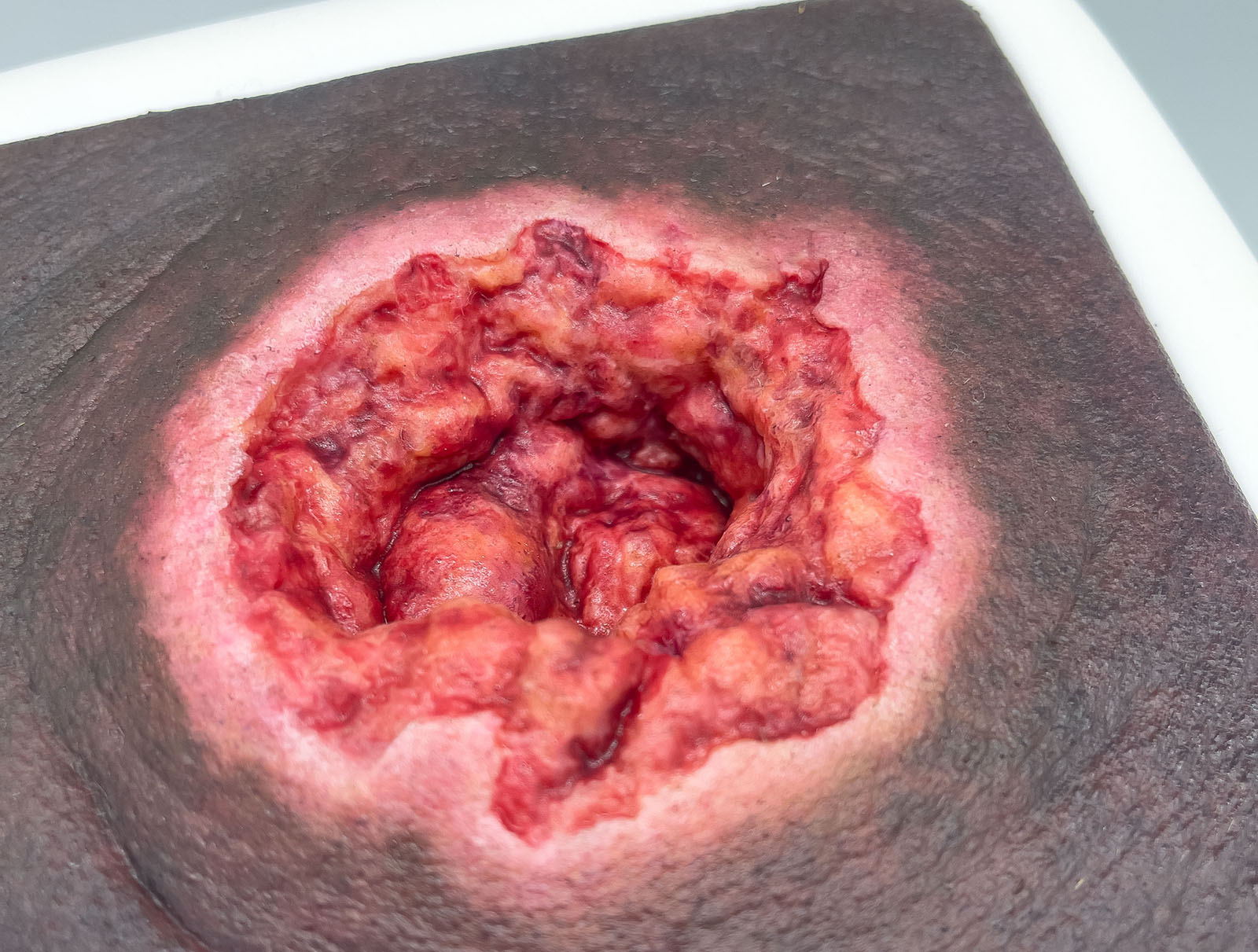 Rahmenmodell Dekubitus mit zerklüftetem Wundrand – Bild 4