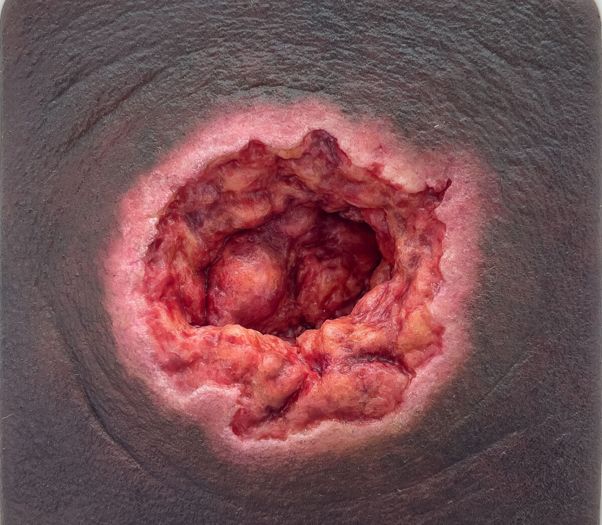 Rahmenmodell Dekubitus mit zerklüftetem Wundrand