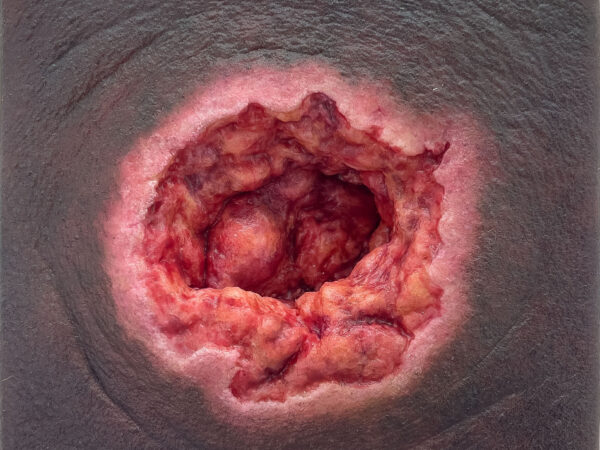 Rahmenmodell Dekubitus mit zerklüftetem Wundrand – Bild 3