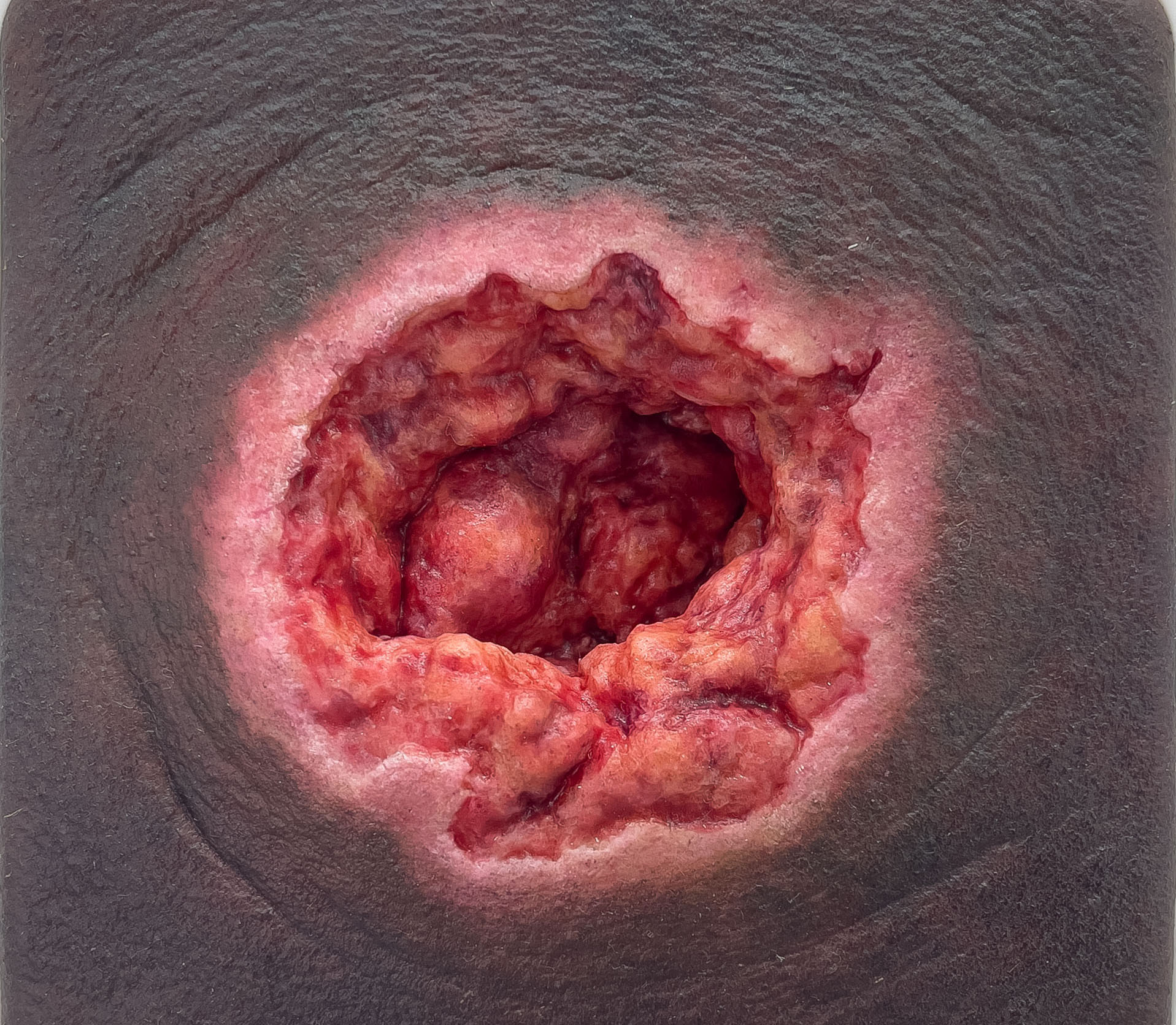 Rahmenmodell Dekubitus mit zerklüftetem Wundrand – Bild 3