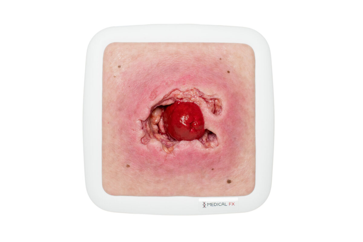 Rahmenmodell Stomaausriss