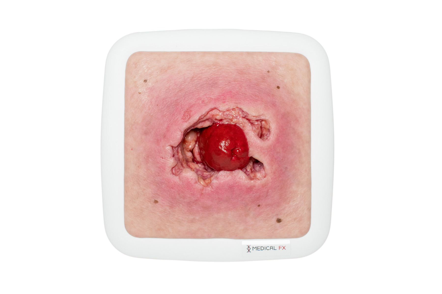 Rahmenmodell Stomaausriss – Bild 1