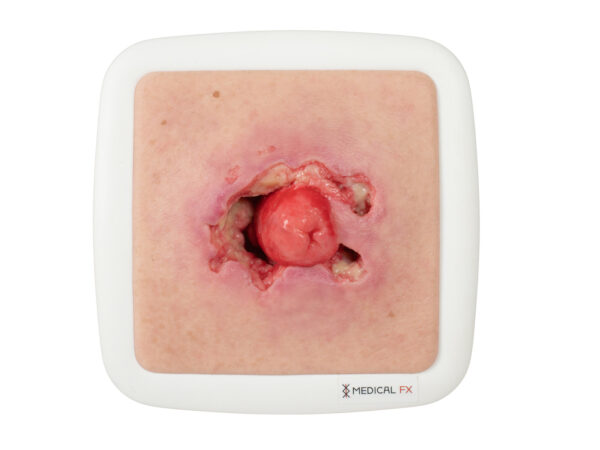 Rahmenmodell Stomaausriss – Bild 7