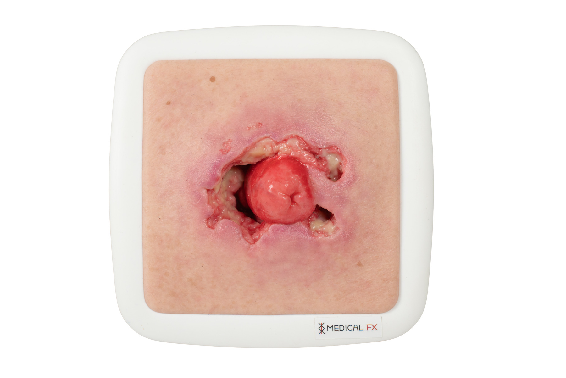 Rahmenmodell Stomaausriss – Bild 7