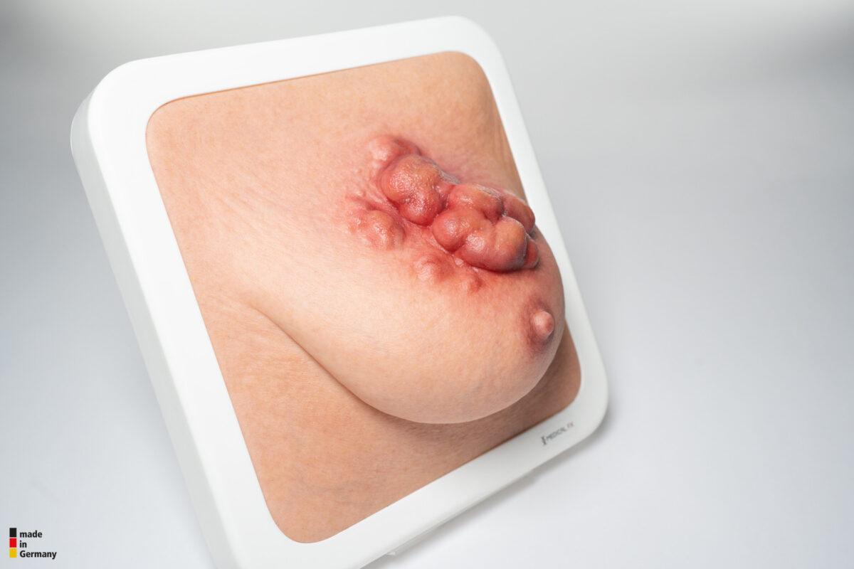 Rahmenmodell Ulcerierendes Mamma-CA (Brusttumor)