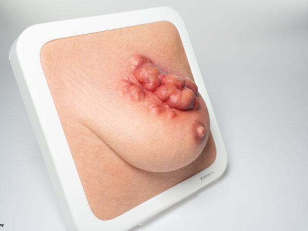 Rahmenmodell Ulcerierendes Mamma-CA (Brusttumor) – Bild 3