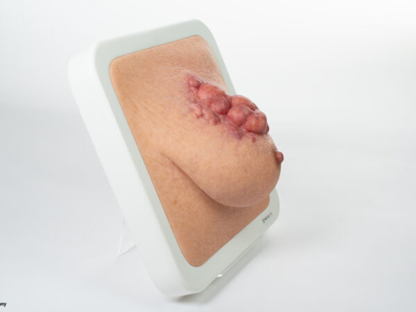 Rahmenmodell Ulcerierendes Mamma-CA (Brusttumor) – Bild 5