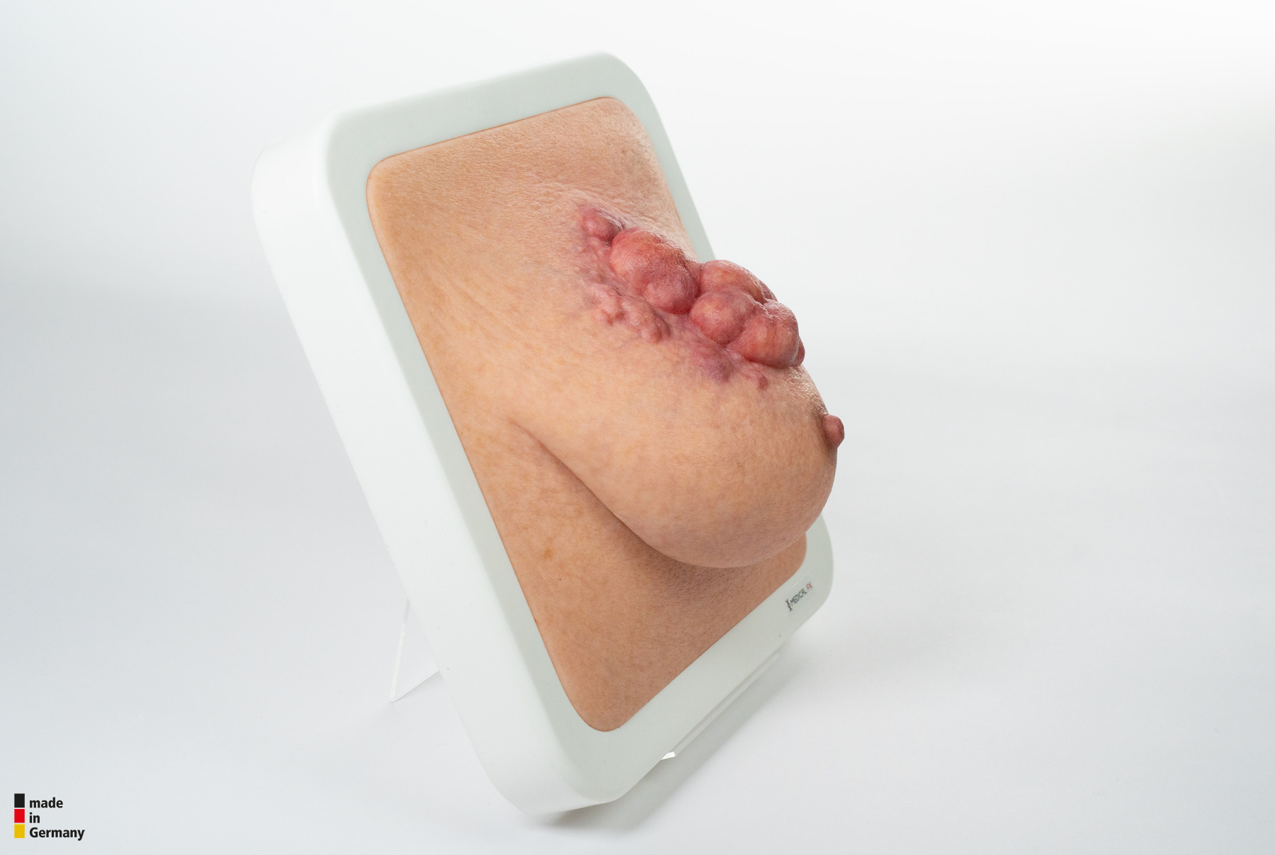 Rahmenmodell Ulcerierendes Mamma-CA (Brusttumor) – Bild 5