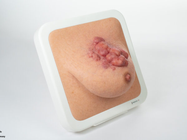 Rahmenmodell Ulcerierendes Mamma-CA (Brusttumor) – Bild 6