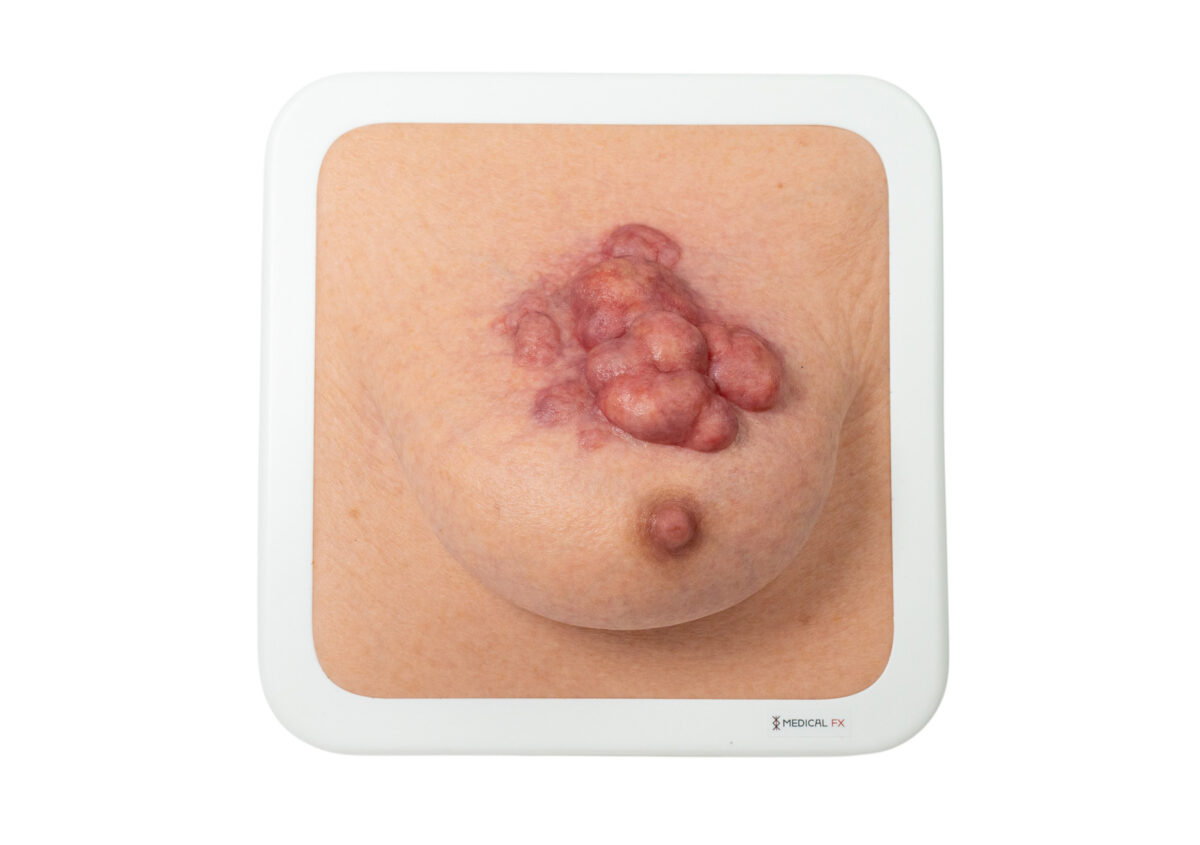 Rahmenmodell Ulcerierendes Mamma-CA (Brusttumor)
