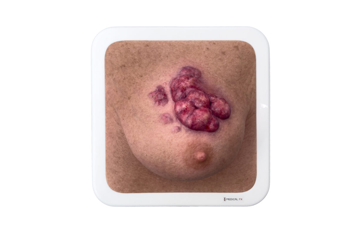 Rahmenmodell Ulcerierendes Mamma-CA (Brusttumor)