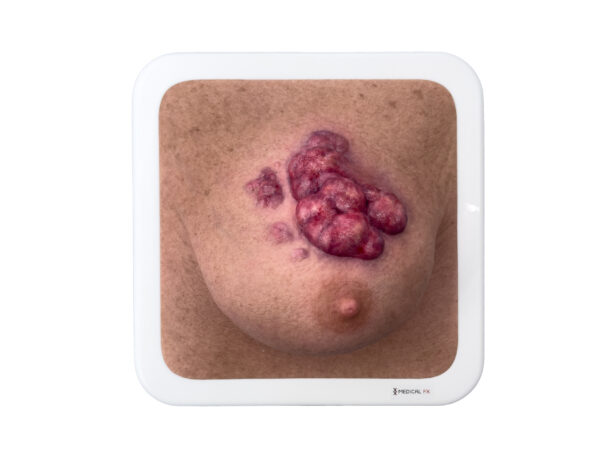 Rahmenmodell Ulcerierendes Mamma-CA (Brusttumor) – Bild 15
