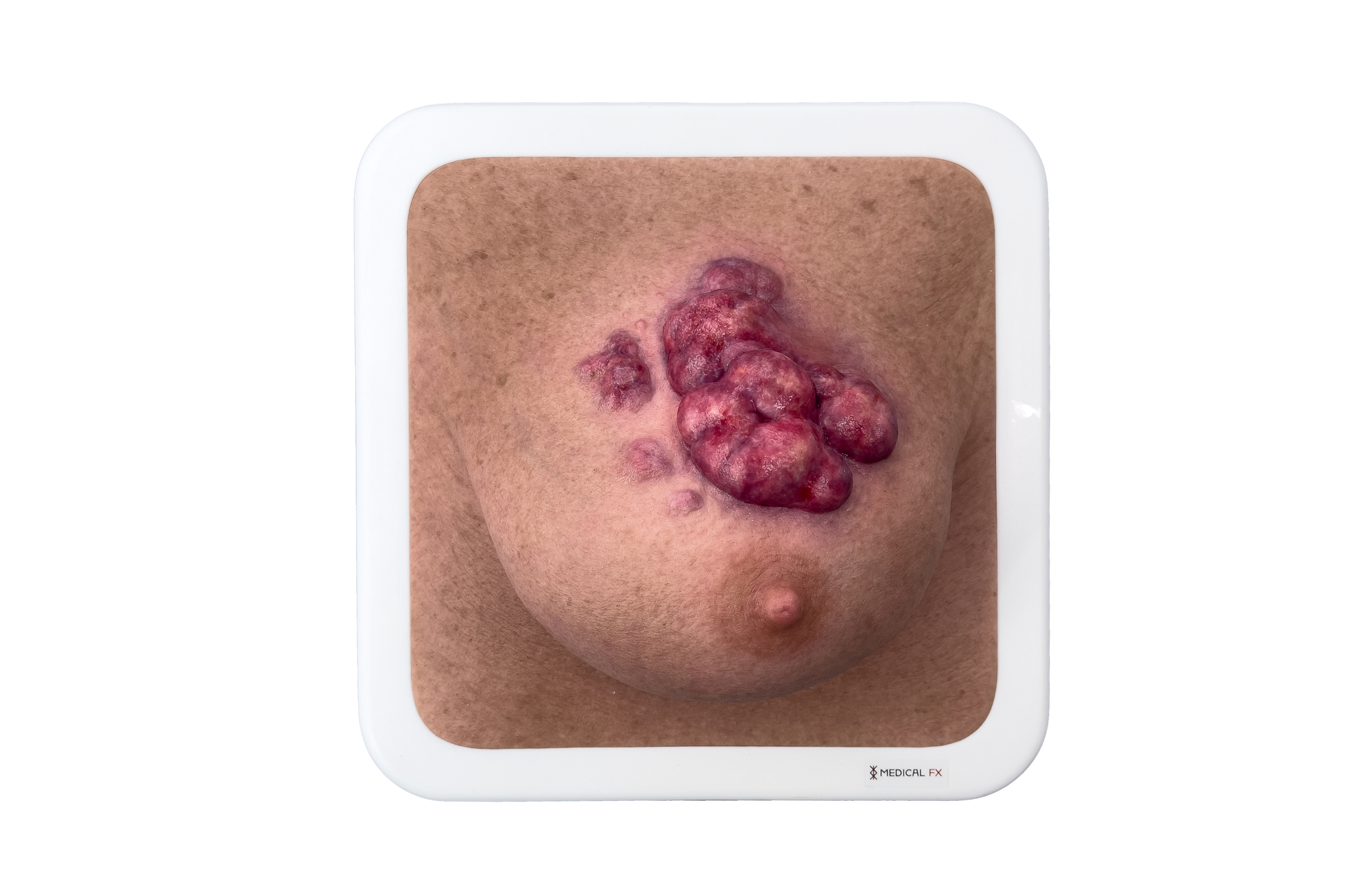 Rahmenmodell Ulcerierendes Mamma-CA (Brusttumor) – Bild 15