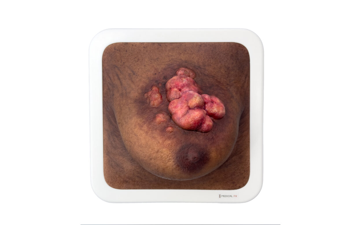 Rahmenmodell Ulcerierendes Mamma-CA (Brusttumor)