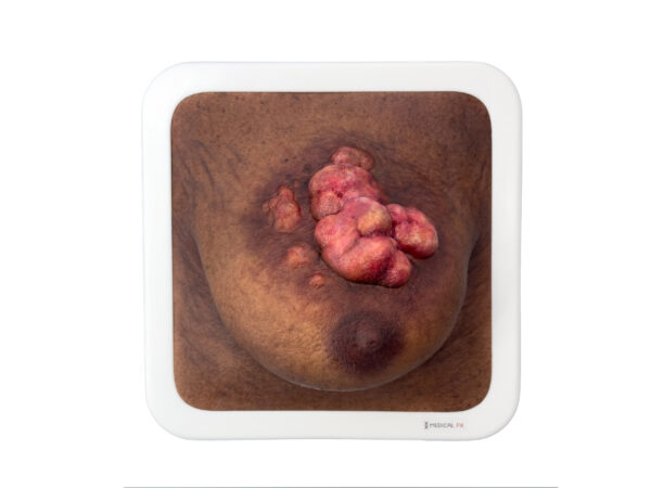 Rahmenmodell Ulcerierendes Mamma-CA (Brusttumor) – Bild 16