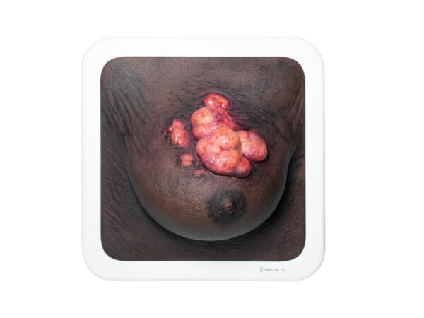 Rahmenmodell Ulcerierendes Mamma-CA (Brusttumor) – Bild 17