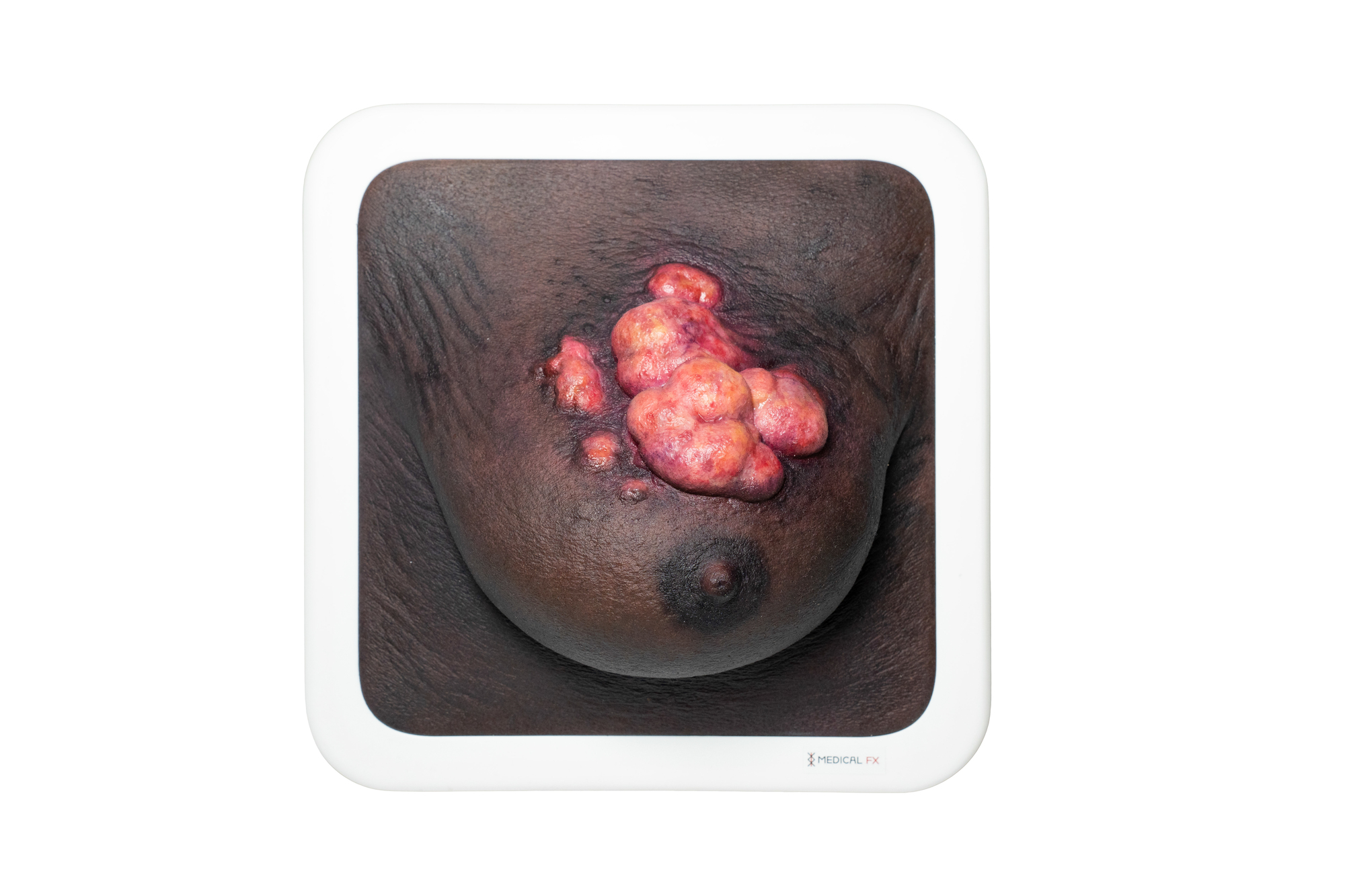 Rahmenmodell Ulcerierendes Mamma-CA (Brusttumor) – Bild 17