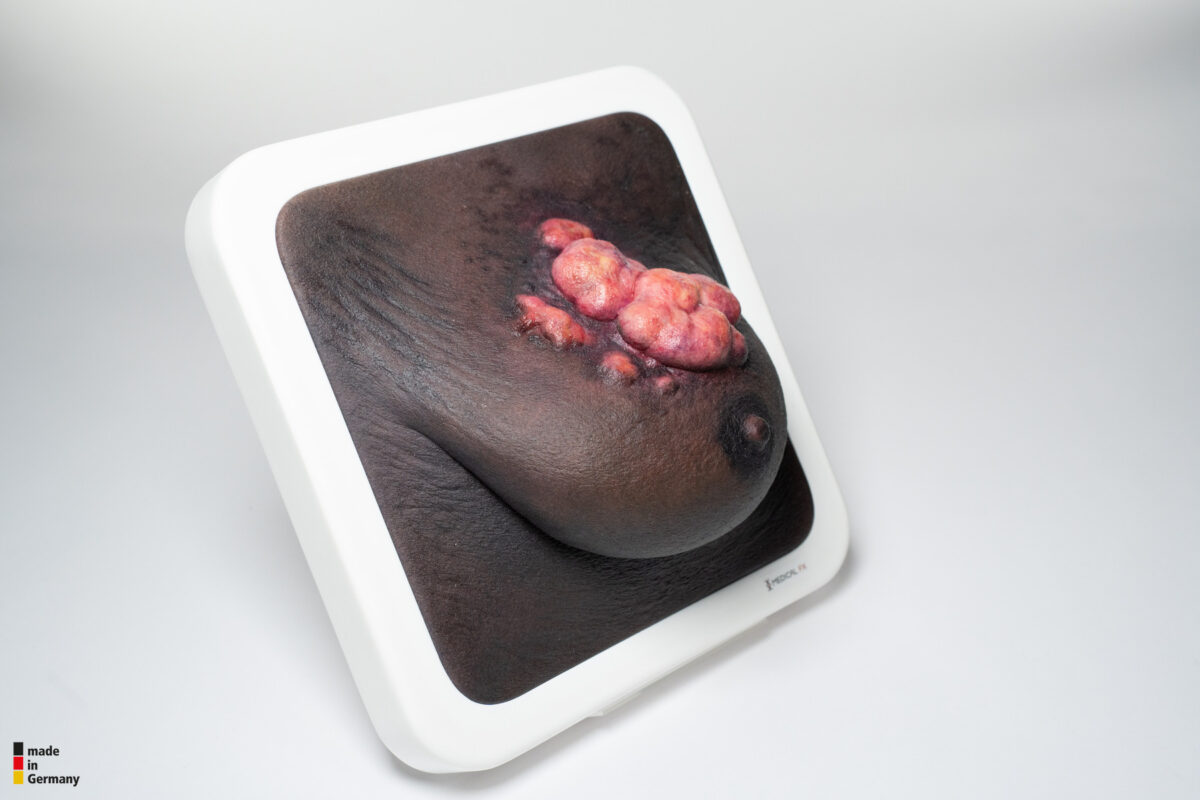Rahmenmodell Ulcerierendes Mamma-CA (Brusttumor)