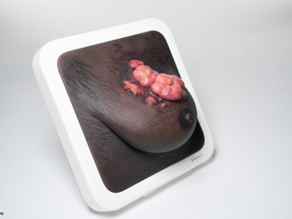 Rahmenmodell Ulcerierendes Mamma-CA (Brusttumor) – Bild 8