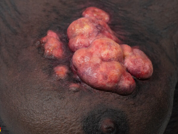 Rahmenmodell Ulcerierendes Mamma-CA (Brusttumor) – Bild 9