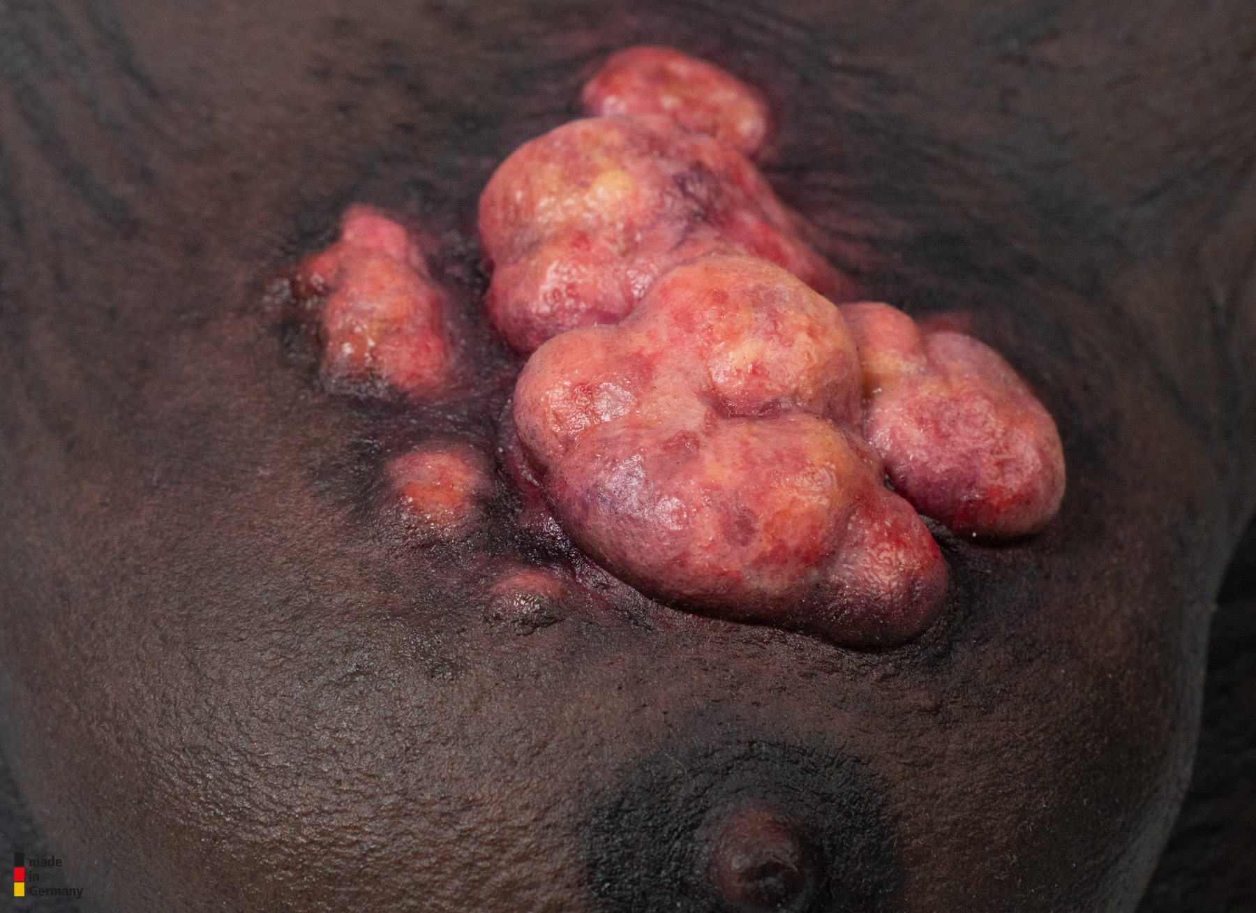 Rahmenmodell Ulcerierendes Mamma-CA (Brusttumor) – Bild 9