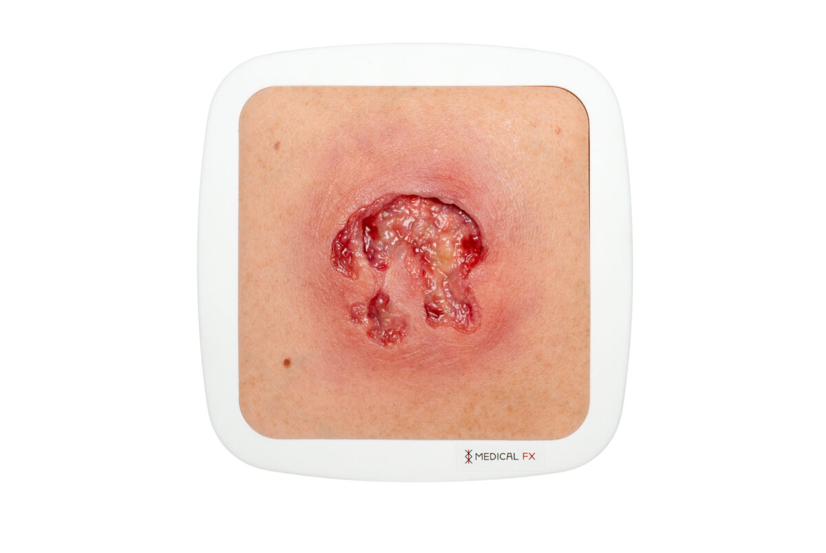 Rahmenmodell Ulcer mit Unterminierung