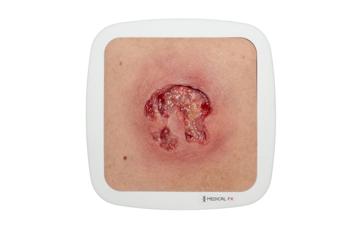 Rahmenmodell Ulcer mit Unterminierung