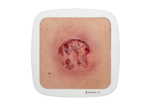 Frame Model Ulcer with Undermining