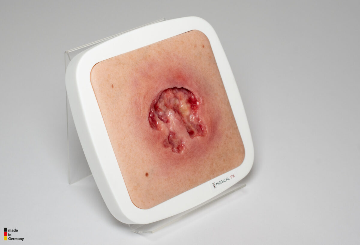 Rahmenmodell Ulcer mit Unterminierung