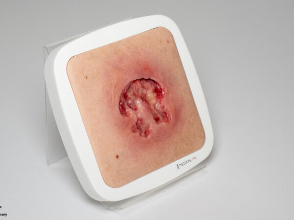 Rahmenmodell Ulcer mit Unterminierung – Bild 2