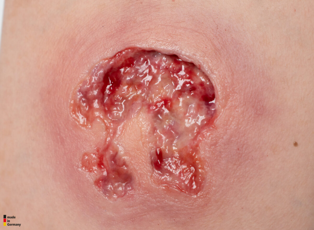 Rahmenmodell Ulcer mit Unterminierung