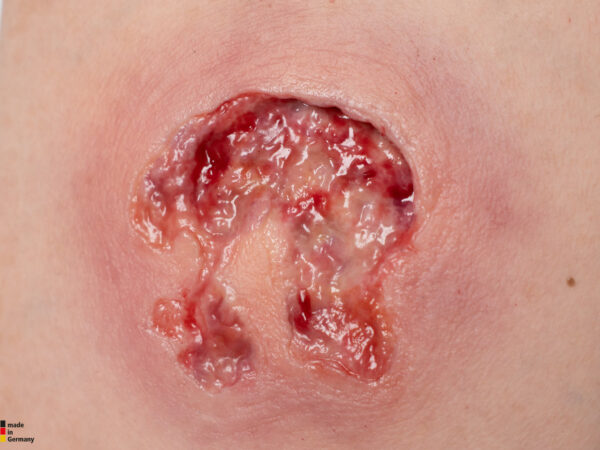 Rahmenmodell Ulcer mit Unterminierung – Bild 3