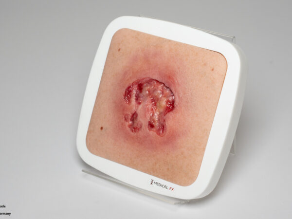 Rahmenmodell Ulcer mit Unterminierung – Bild 4