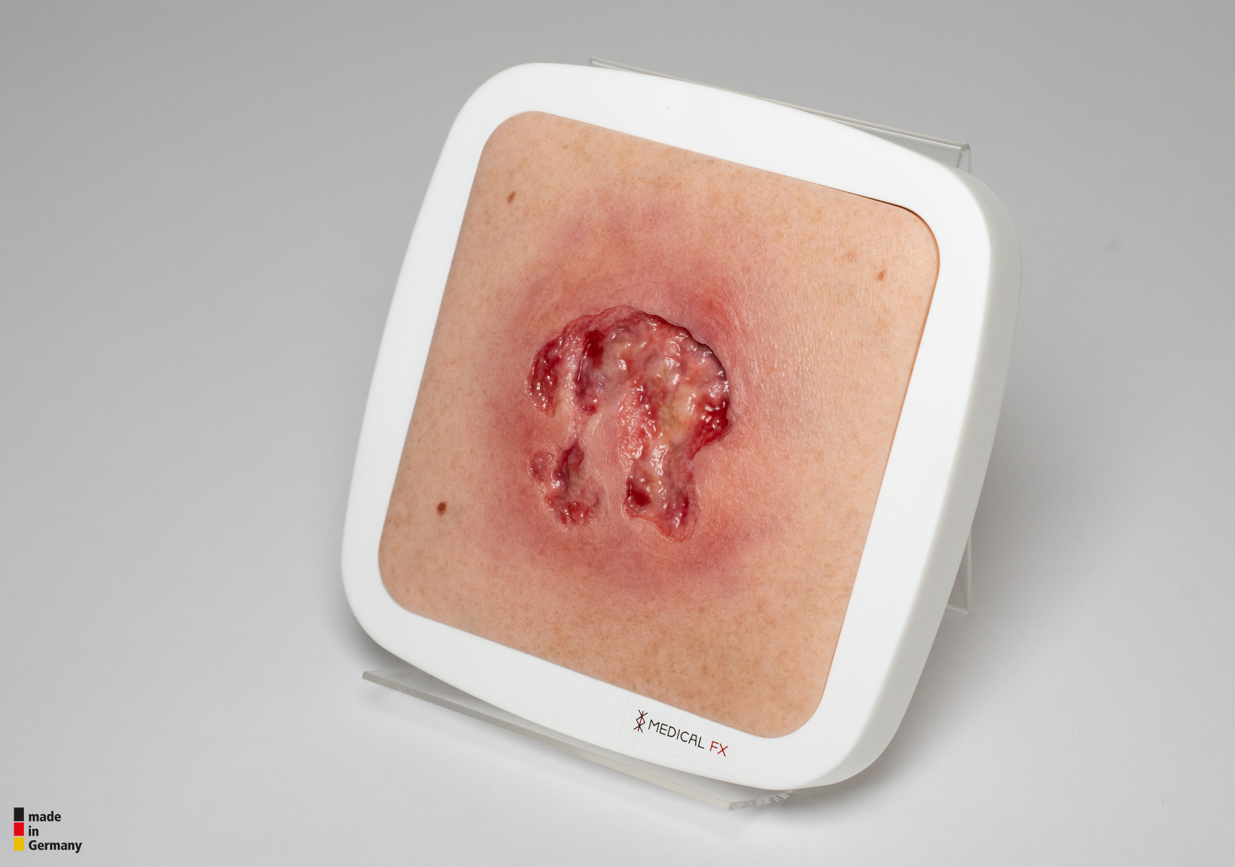 Rahmenmodell Ulcer mit Unterminierung – Bild 4