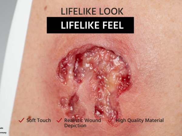 Rahmenmodell Ulcer mit Unterminierung – Bild 5