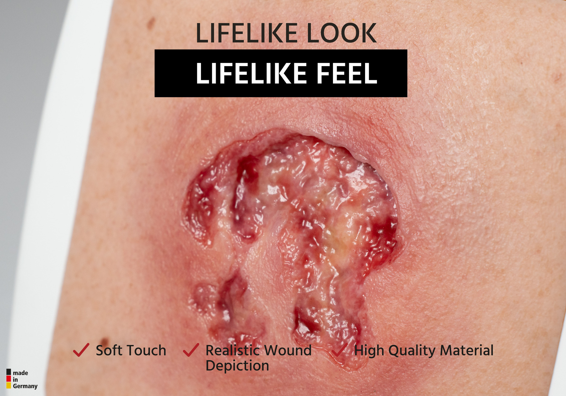 Rahmenmodell Ulcer mit Unterminierung – Bild 5