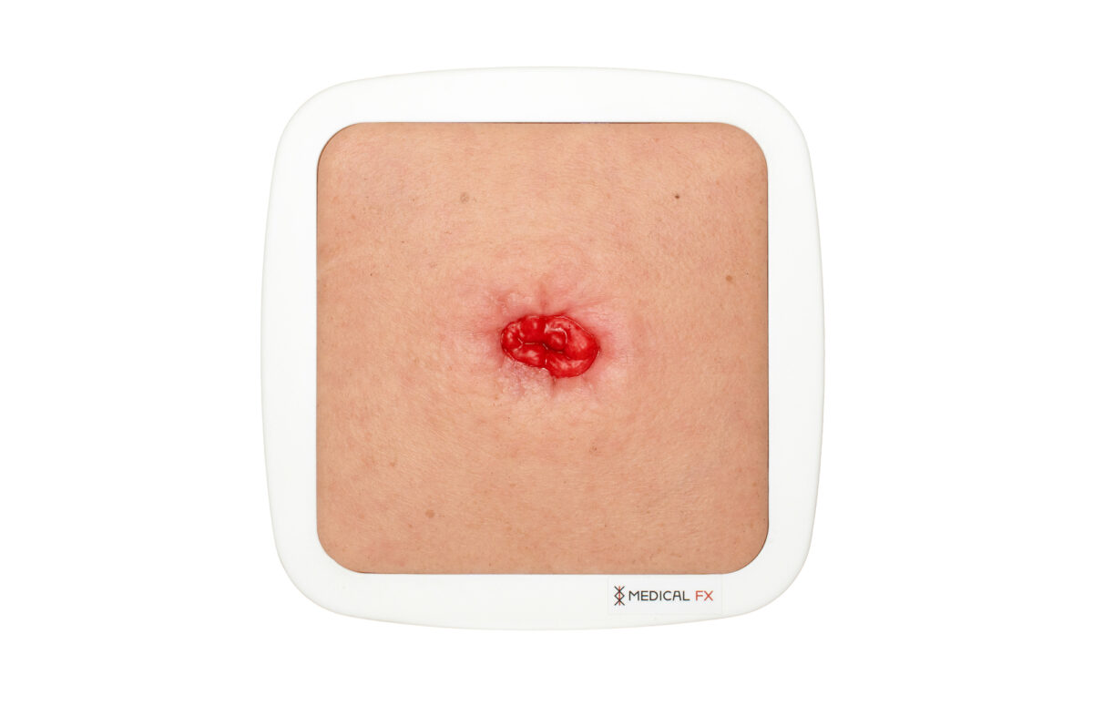 Rahmenmodell Stoma in einer Mulde