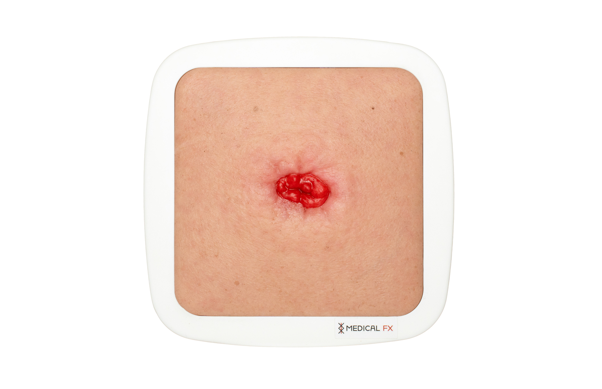 Rahmenmodell Stoma in einer Mulde – Bild 1