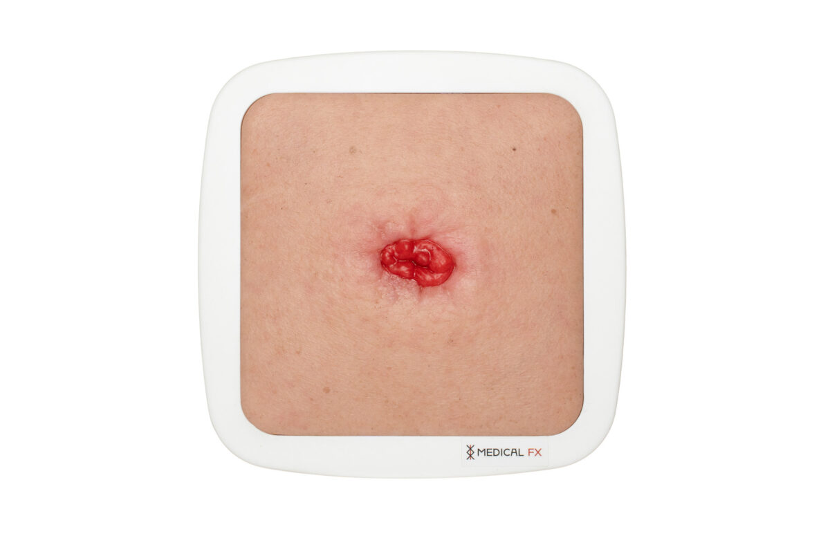 Rahmenmodell Stoma in einer Mulde