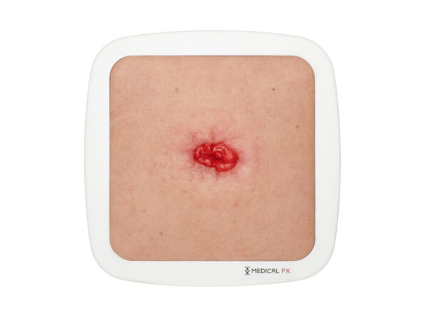 Frame Model Stoma in a Hollow