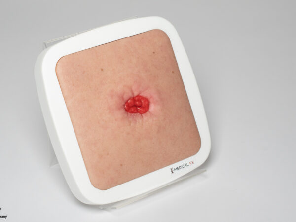 Rahmenmodell Stoma in einer Mulde – Bild 2